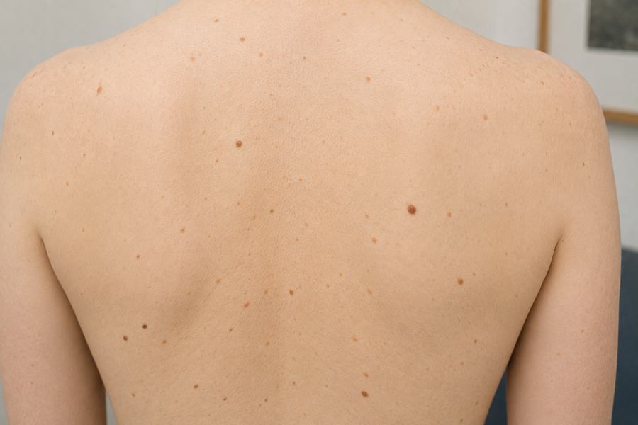 Changing Mole – Hautmedizin Westend