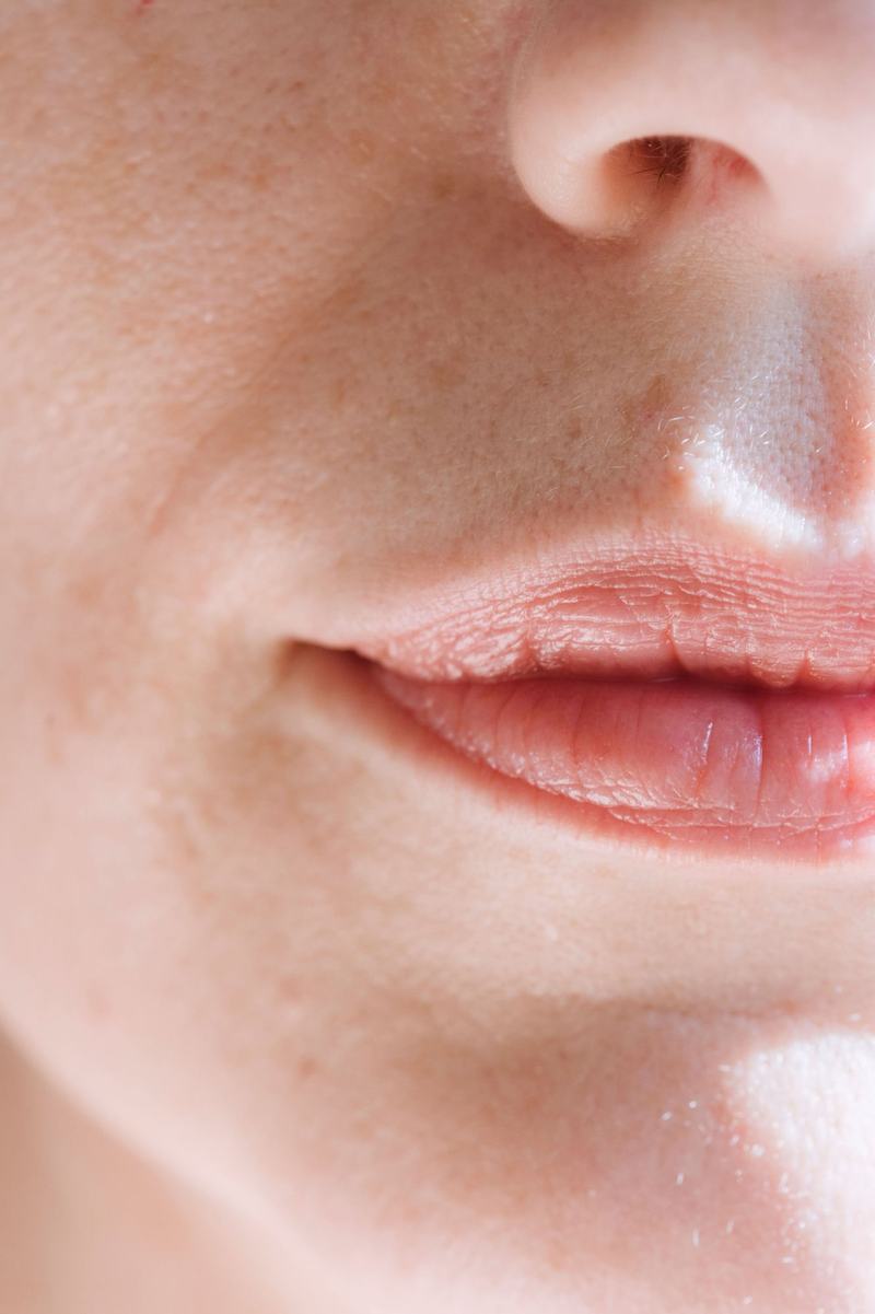 Lip Volume & Lip Contour – Hautmedizin Westend